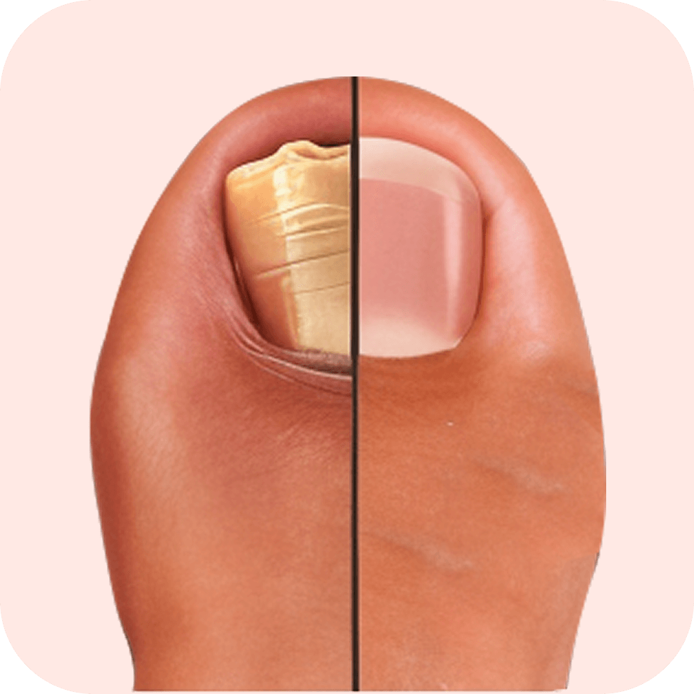 Tirnoq plastinkalarining qorayishi